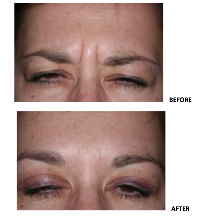 Botox from harry Singh Botox Clinic