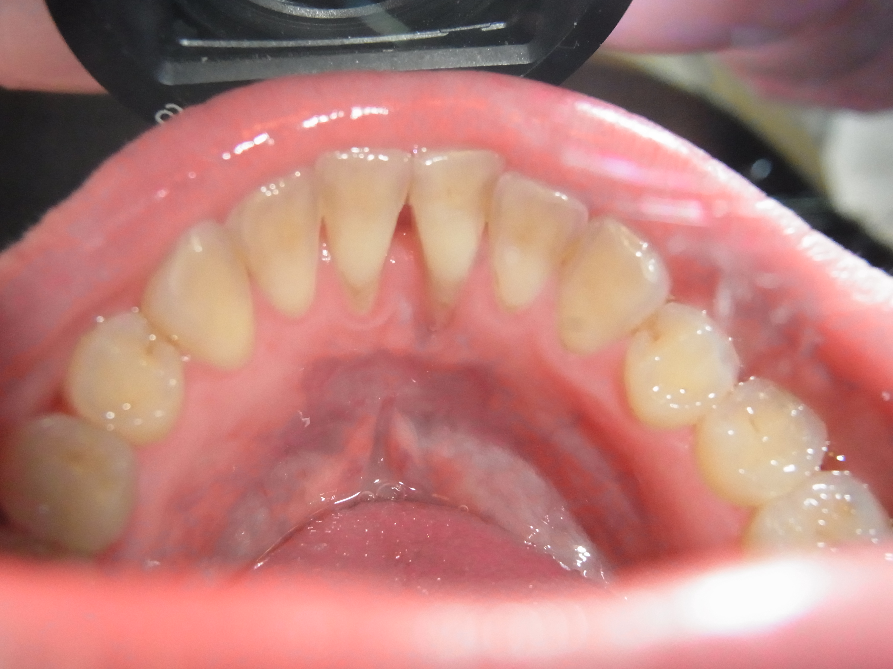 how-a-tongue-piercing-can-cause-serious-damage-to-the-teeth-and-gums