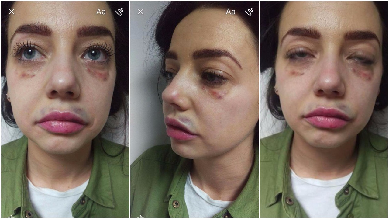 Shocking botched beauty treatment illustrates just why ‘time is more valuable than money’ 