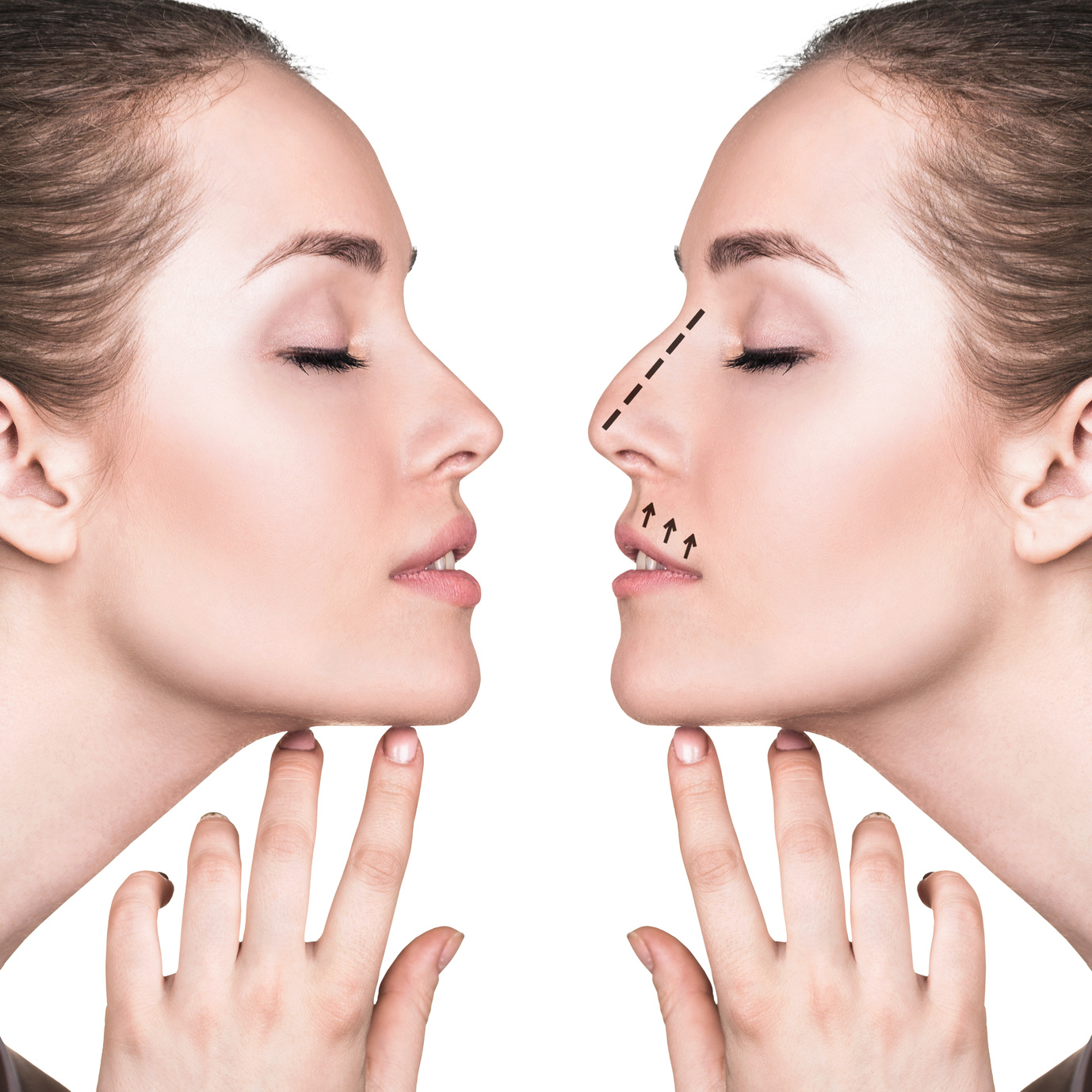  Bruise free Nose Jobs Comparethetreatment