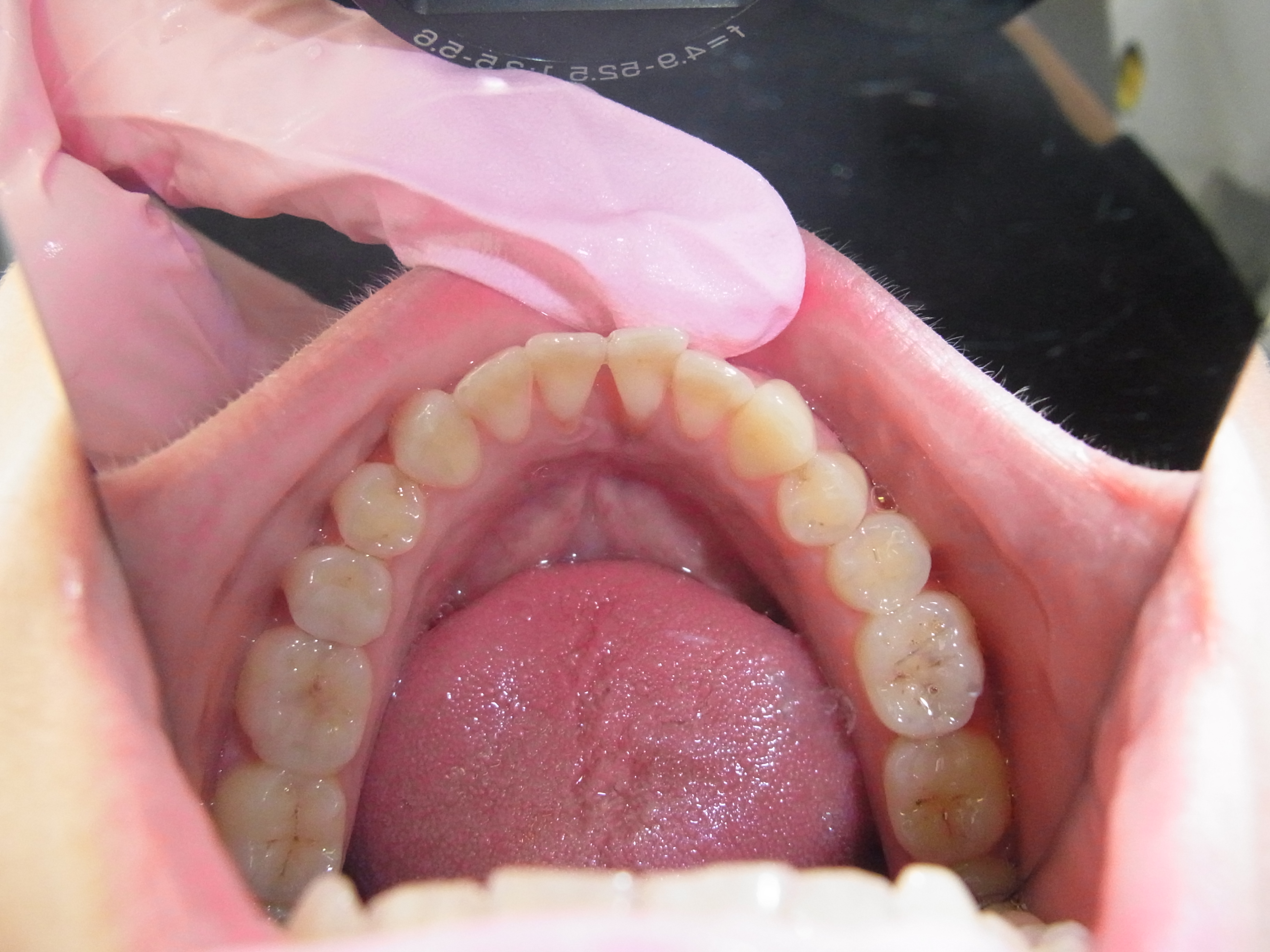 Do Plastic Tongue Bars Damage Teeth At Yvonne Ames Blog