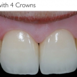 precise planning with the patient to provide their ideal smile with new crowns