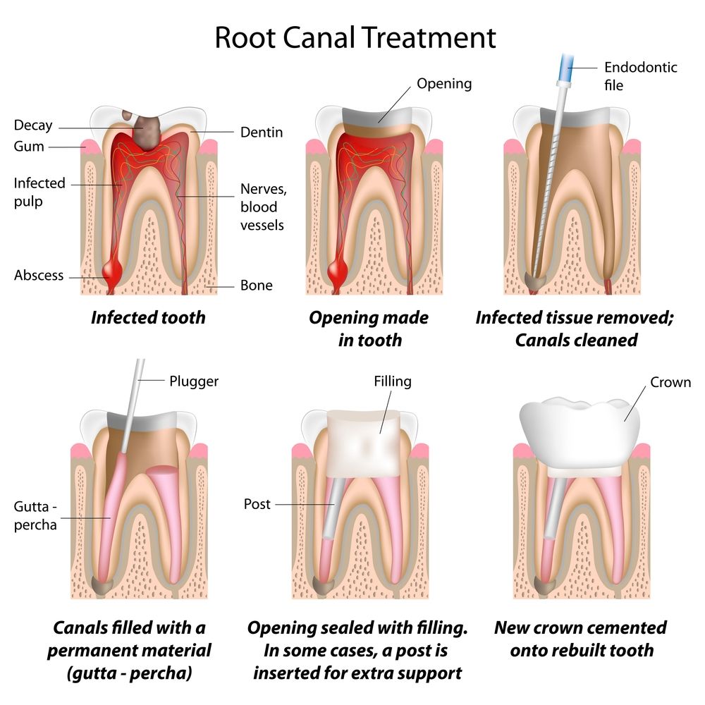 What is Root Canal Treatment? Centre for Dentistry explains.