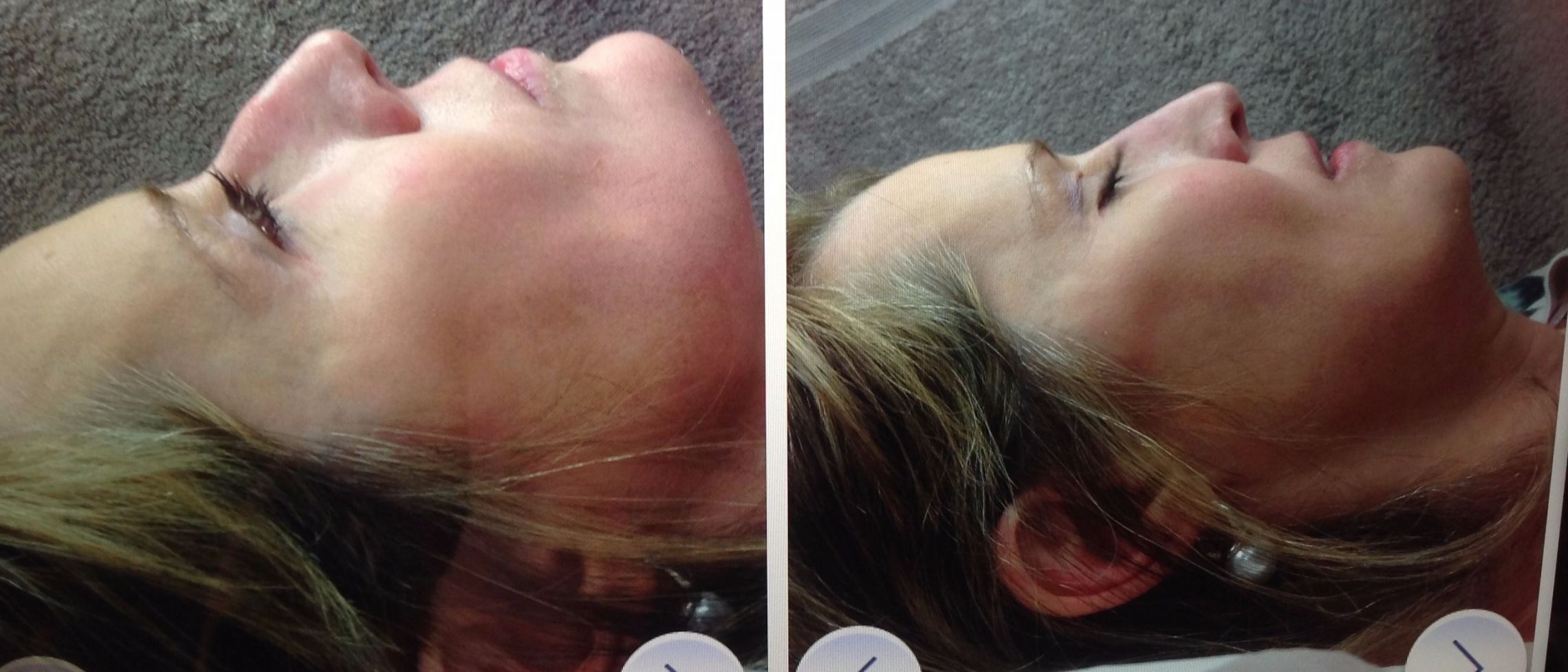 Before and afters of nose augmentation with dermal fill – Straightens that crooked nose without surgery