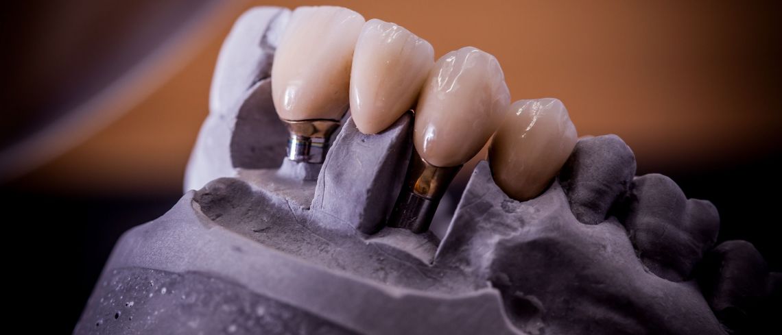 World class ceramists at Andrea Ubhi Dentistry in York
