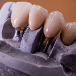 World class ceramists at Andrea Ubhi Dentistry in York