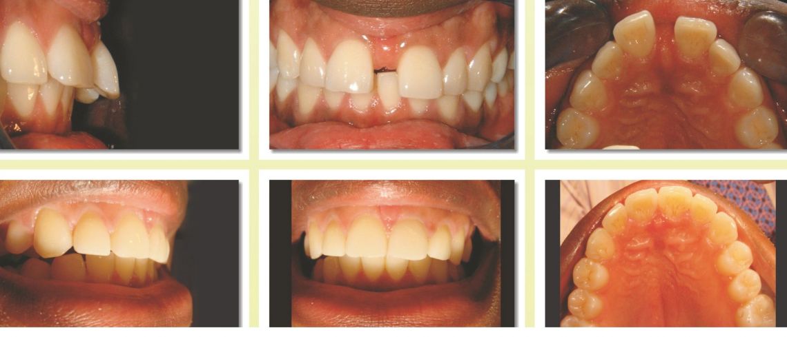 Invisalign for spaces