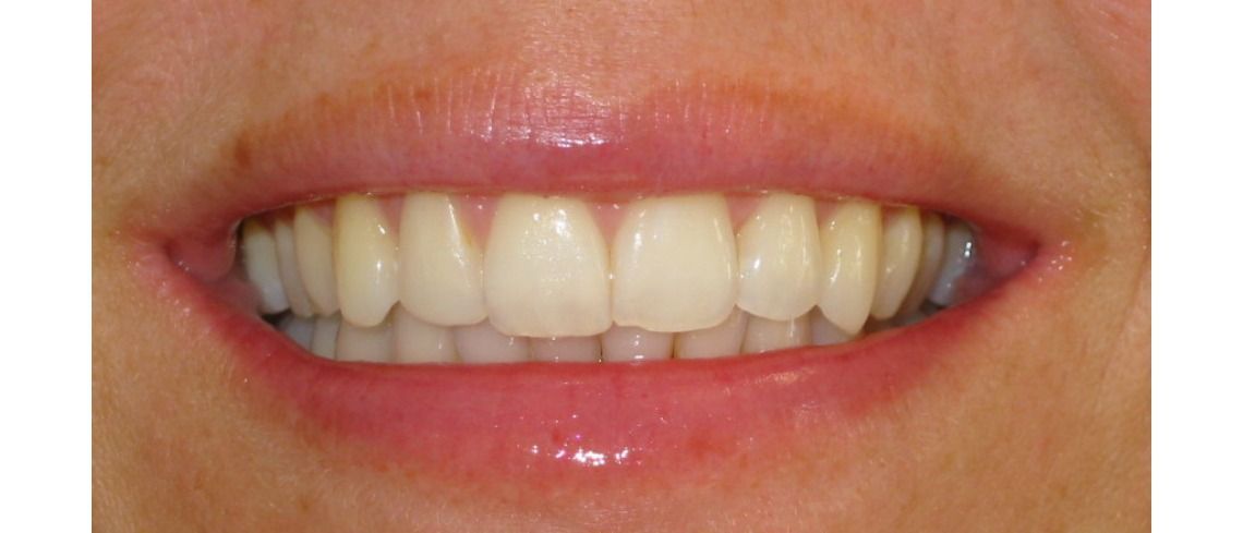 After Invisalign and Whitening