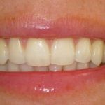 After Invisalign and Whitening