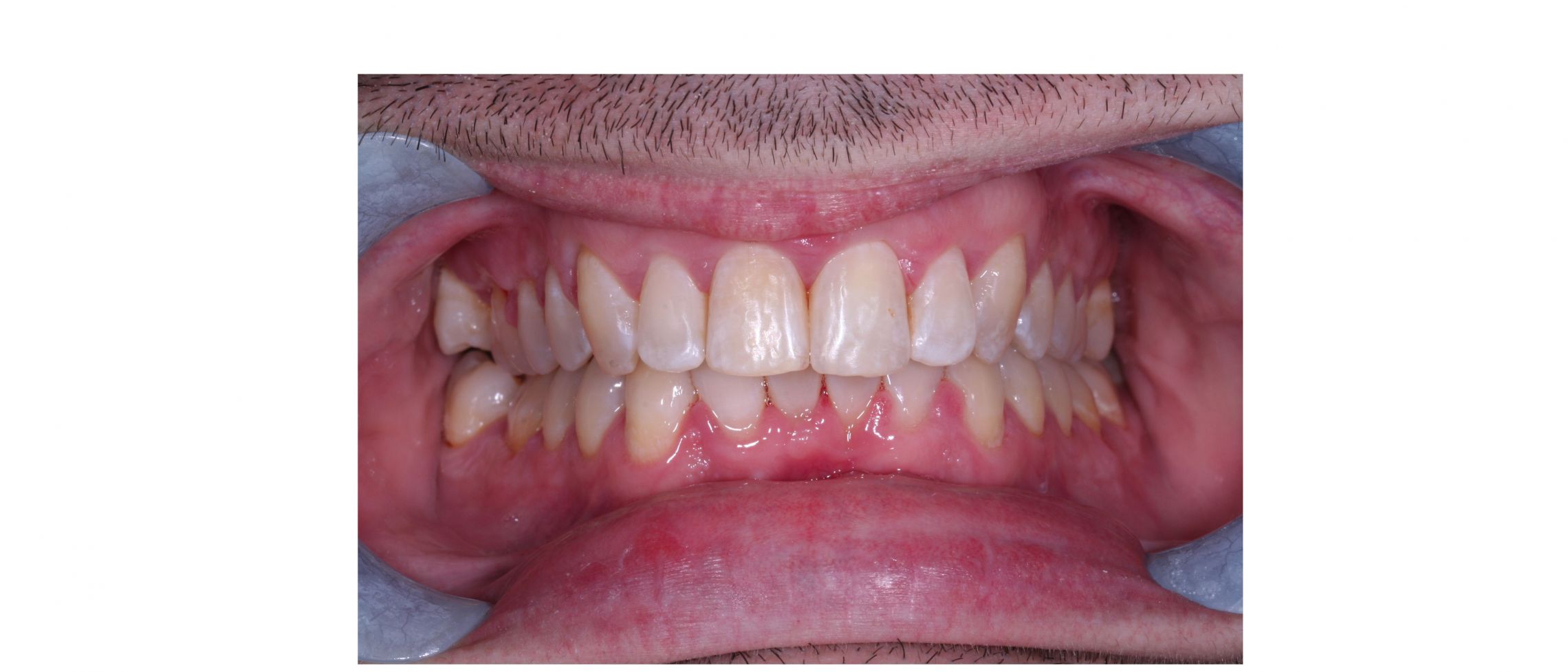 case6 - after treatment