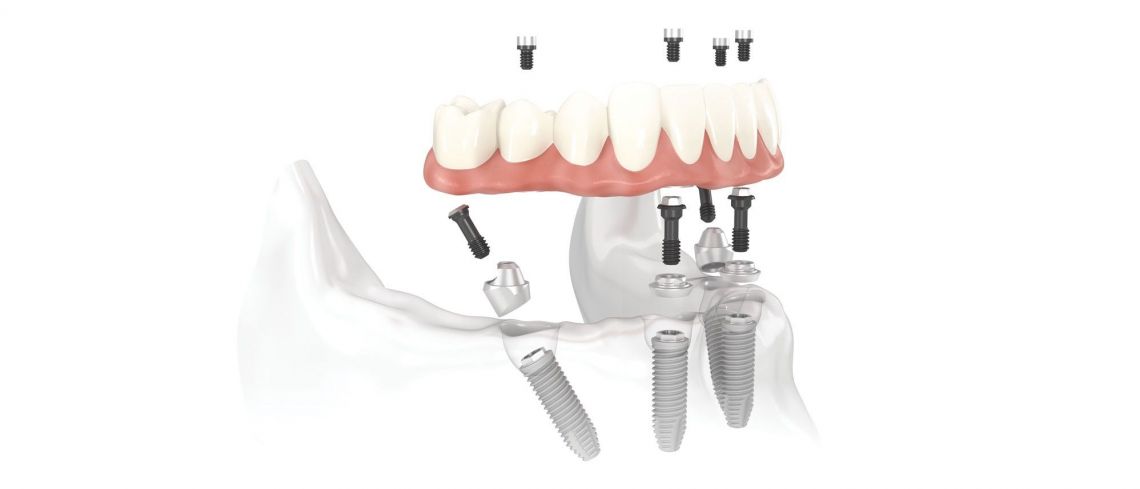 Blossom Dental Care & Implant Studio