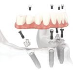 Blossom Dental Care & Implant Studio