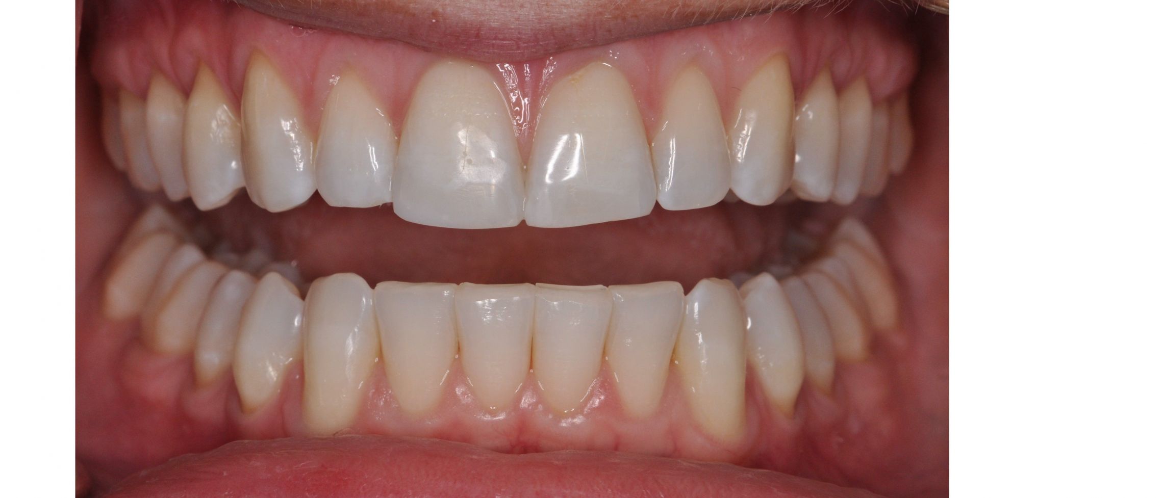 After Invisalign, free whitening and bonding.