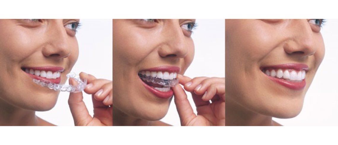 Incisalign aligners 