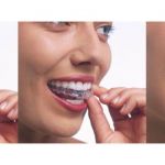 Incisalign aligners 