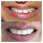 Smile design with veneers and teeth whitening 