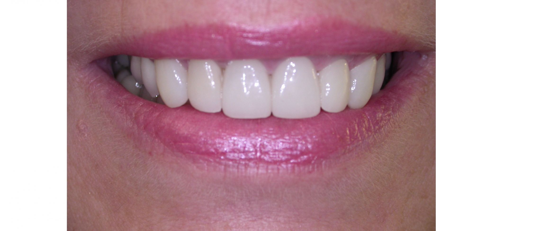 After Crowns/Veneers