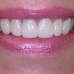 After Crowns/Veneers