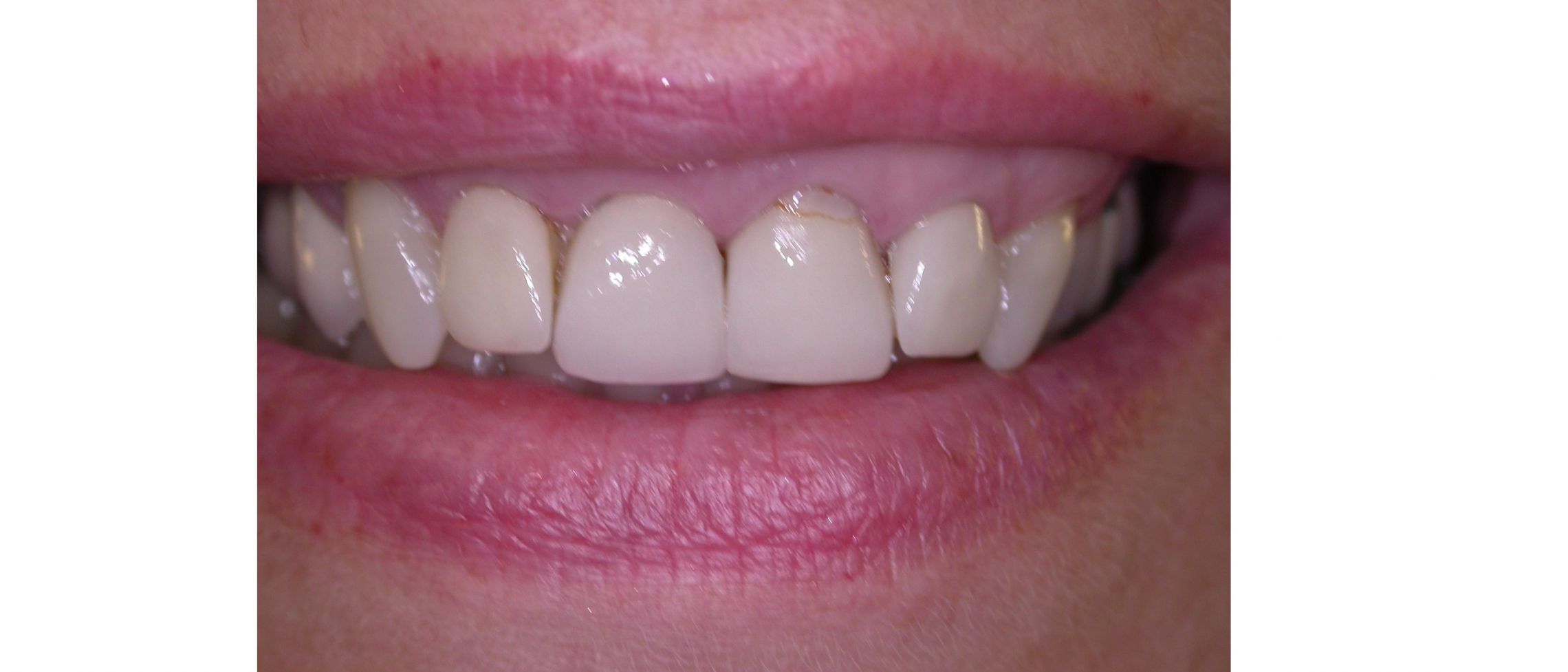 Before Crowns/Veneers