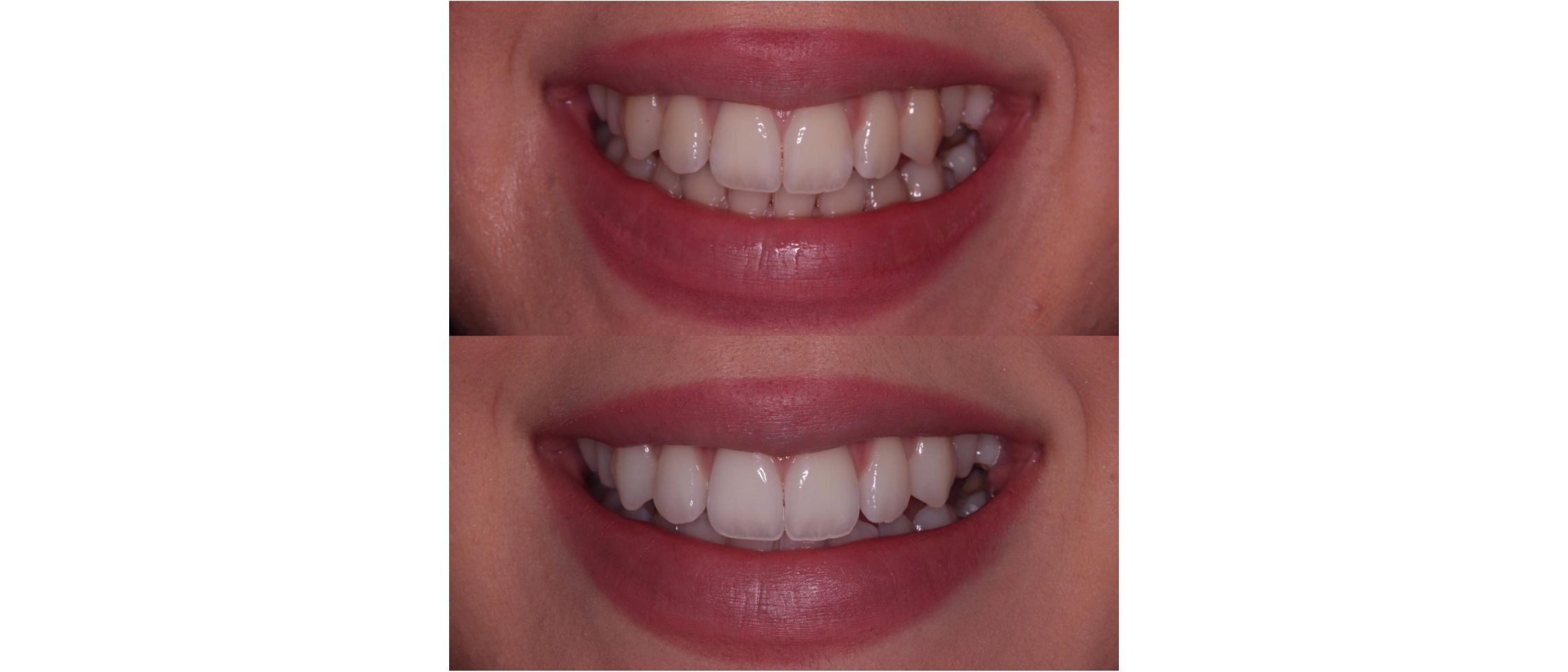 Teeth whitening 