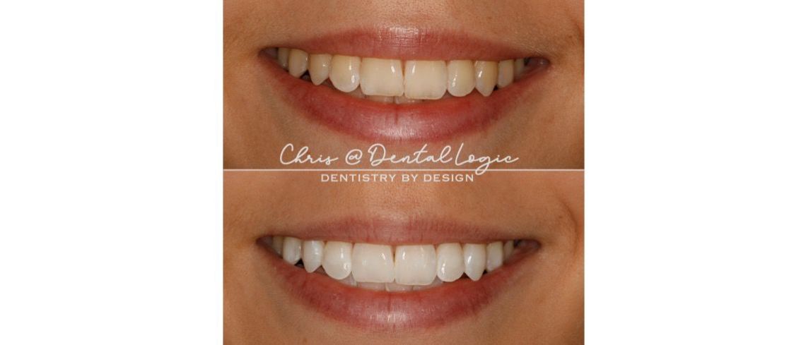 Simple Whitening