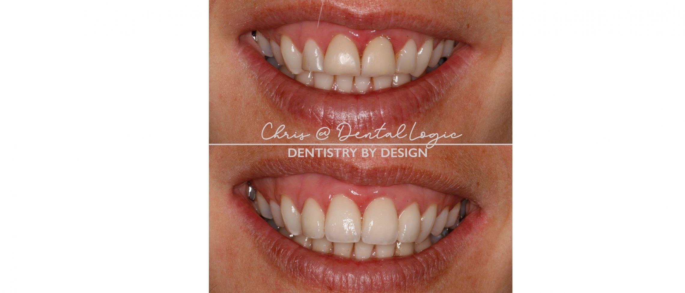 Dental Veneers