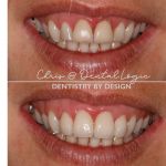 Dental Veneers