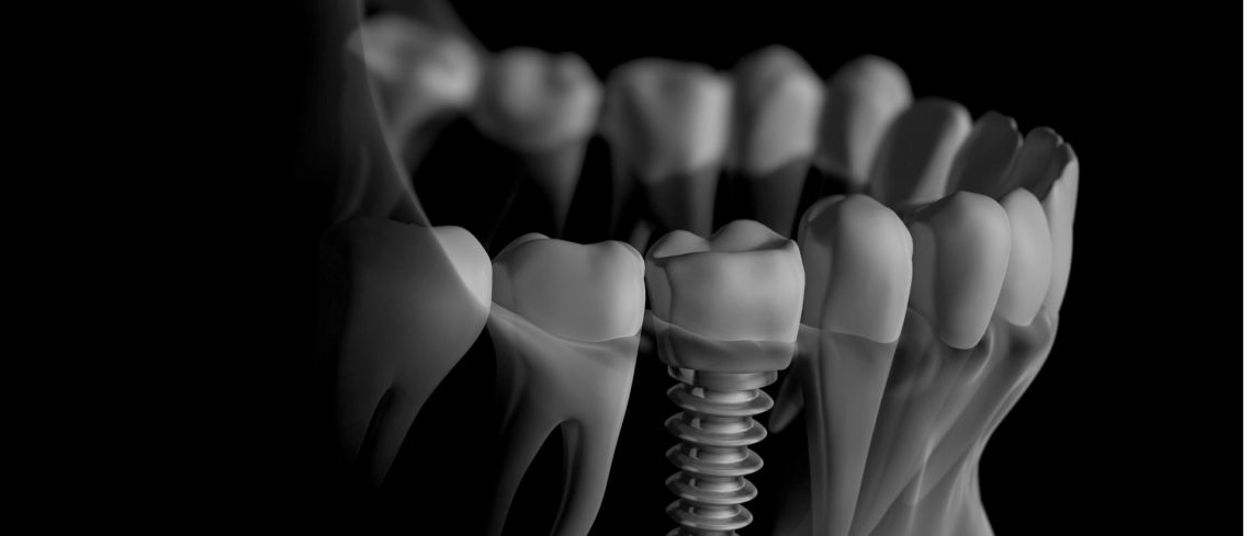 dental Implants