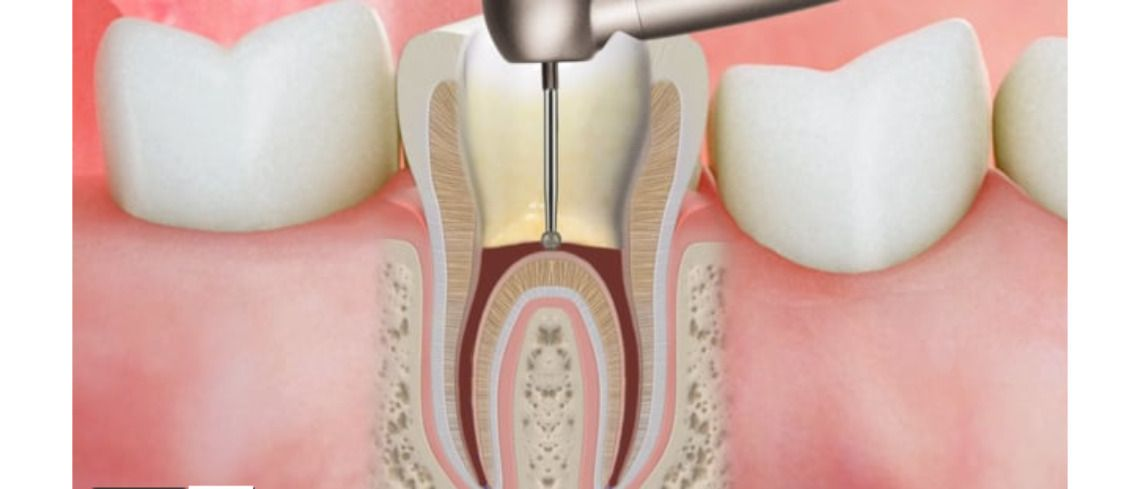 root canal