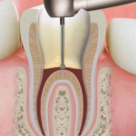 root canal