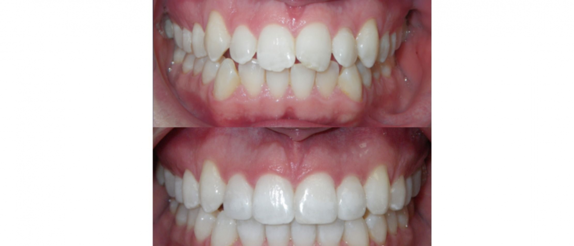 Invisalign braces before after london