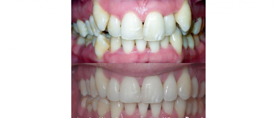Orthodontic braces before after