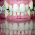 Orthodontic braces before after