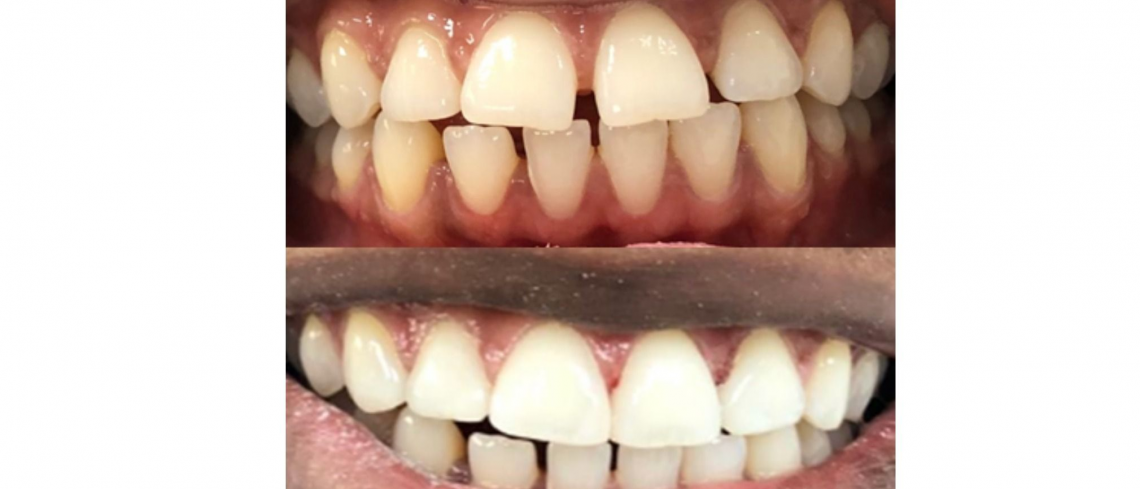 Gappy teeth corrected with composite bonding. Before after.