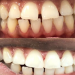 Gappy teeth corrected with composite bonding. Before after.