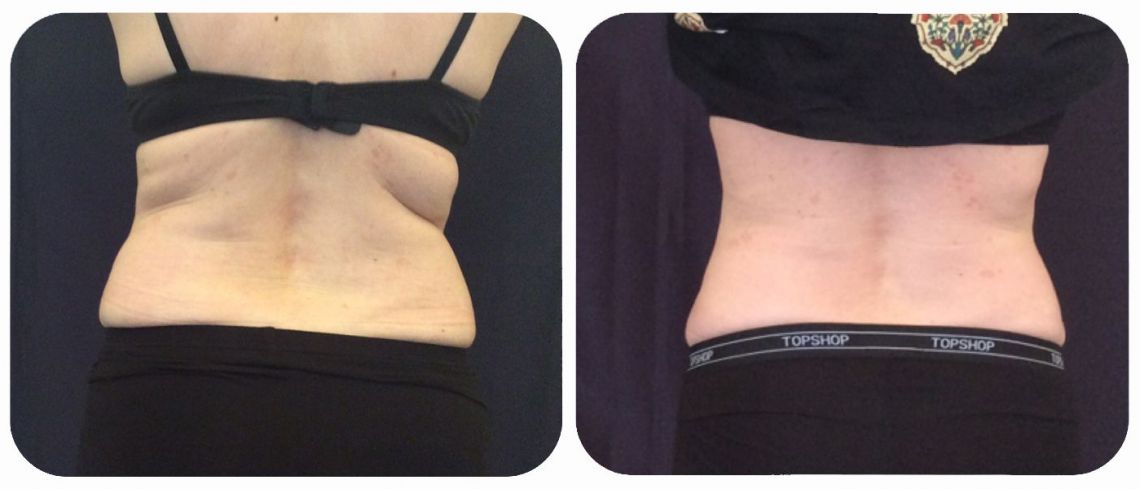 Bra & Back Fat Treatment Surrey