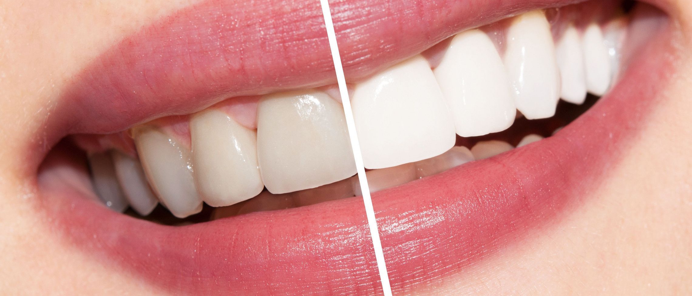 Choose right before you go white – why whitening can be frightening if you get it wrong