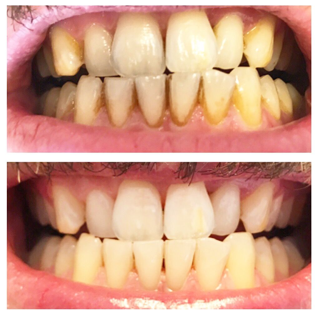 teeth stain removal before airflow smile whitening brighter comparethetreatment versus