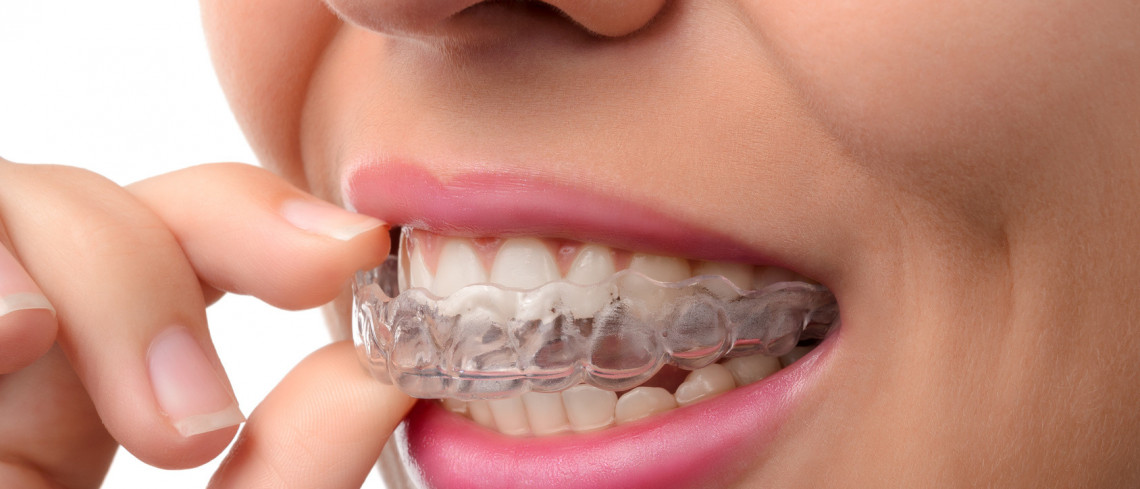 Removable Braces (Clear Aligners)