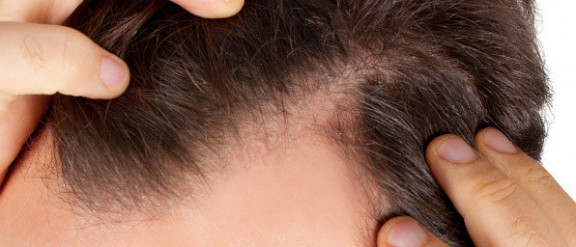 Mesotherapy for Alopecia, Baldness and Hair Loss