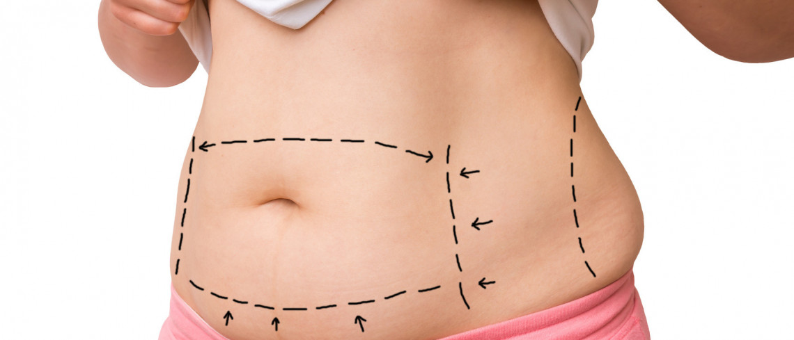 Surgical Fat Reduction