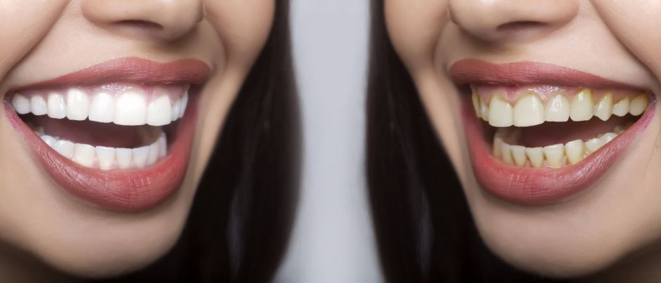 Teeth Whitening